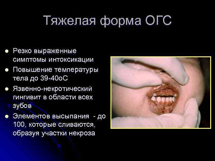 Тяжелая форма ОГС l l Резко выраженные симптомы интоксикации Повышение температуры тела до 39