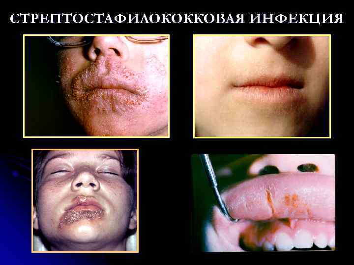 СТРЕПТОСТАФИЛОКОККОВАЯ ИНФЕКЦИЯ 