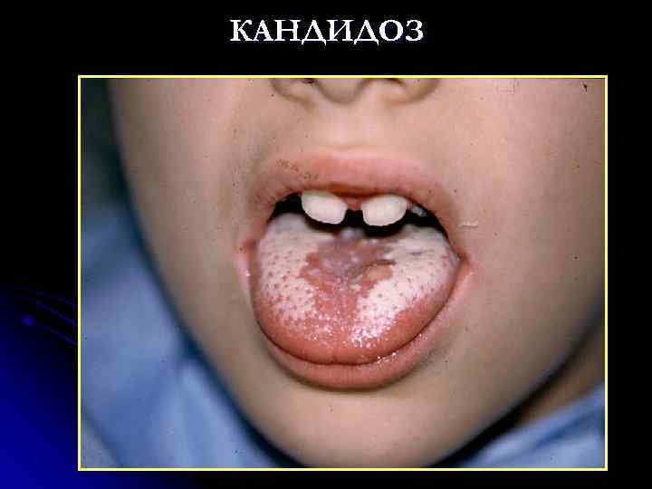 КАНДИДОЗ 