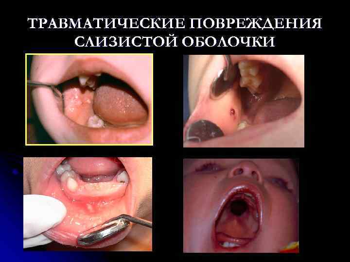 ТРАВМАТИЧЕСКИЕ ПОВРЕЖДЕНИЯ СЛИЗИСТОЙ ОБОЛОЧКИ 