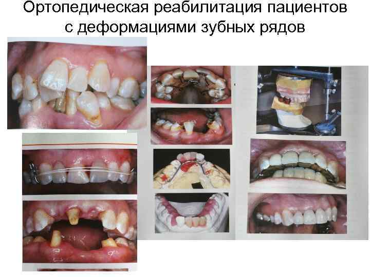 Ортопедическая реабилитация пациентов с деформациями зубных рядов 