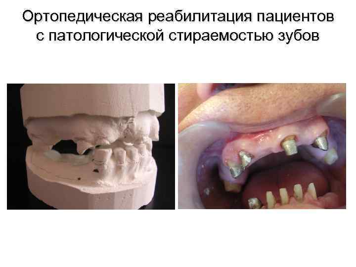 Ортопедическая реабилитация пациентов с патологической стираемостью зубов 