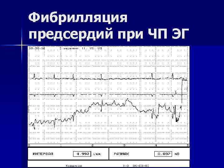 Фибрилляция предсердий при ЧП ЭГ 