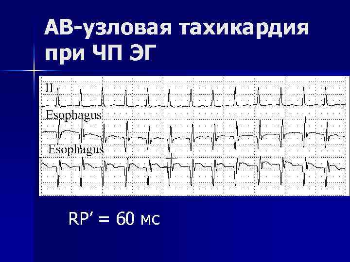 АВ-узловая тахикардия при ЧП ЭГ RP’ = 60 мс 