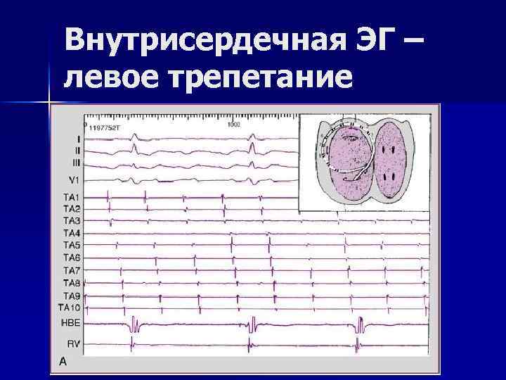 Внутрисердечная ЭГ – левое трепетание 