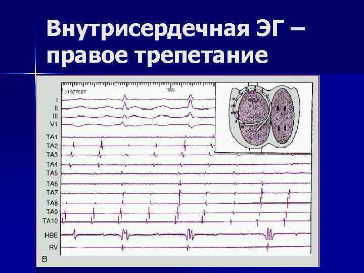 Внутрисердечная ЭГ – правое трепетание 