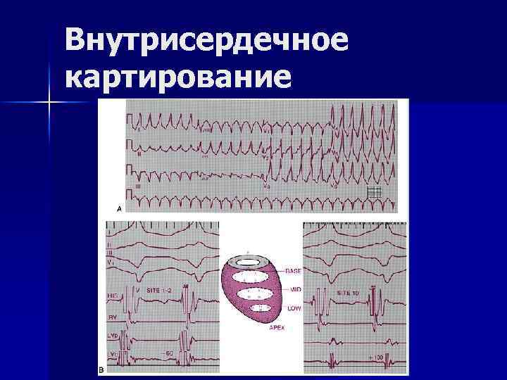 Внутрисердечное картирование 