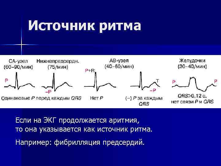 Источник ритма Если на ЭКГ продолжается аритмия, то она указывается как источник ритма. Например: