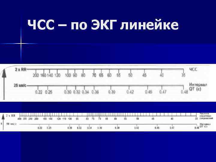 ЧСС – по ЭКГ линейке 