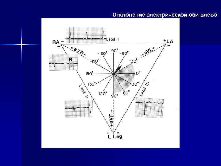 Отклонение электрической оси влево 