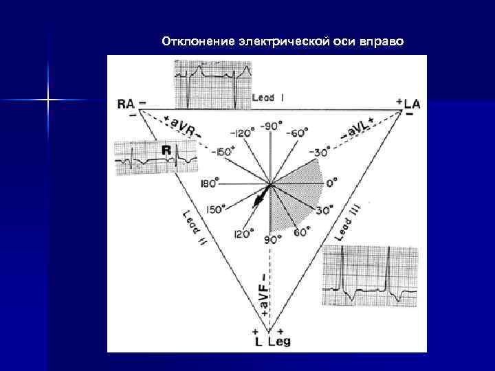 Отклонение электрической оси вправо 