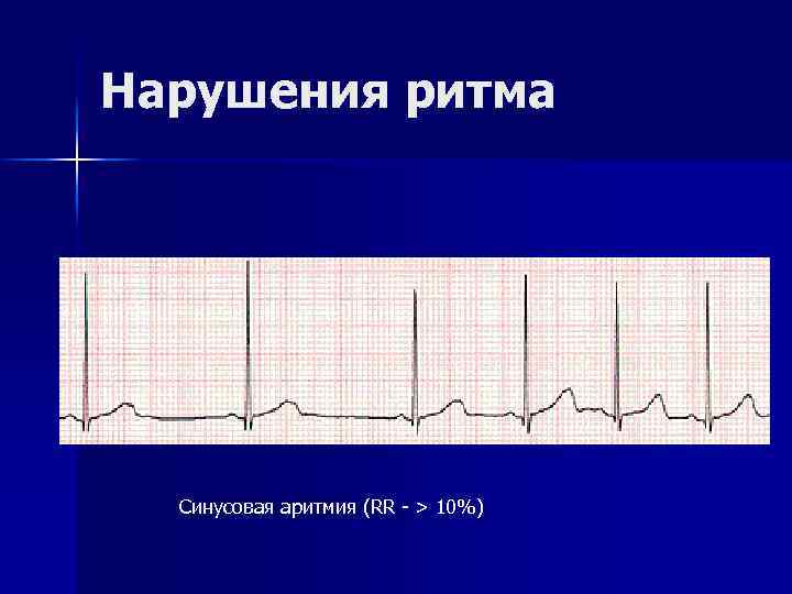 Нарушения ритма Синусовая аритмия (RR - > 10%) 