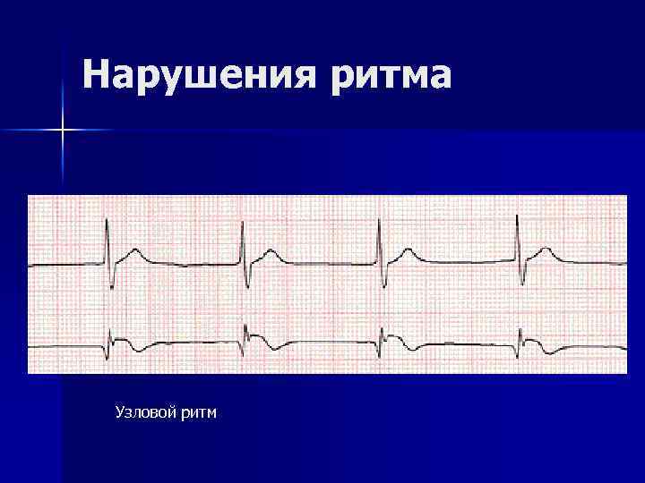 Нарушения ритма Узловой ритм 