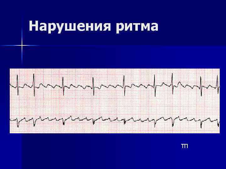 Нарушения ритма ТП 