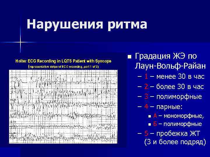 Нарушения ритма n Градация ЖЭ по Лаун-Вольф-Райан – – 1 – менее 30 в