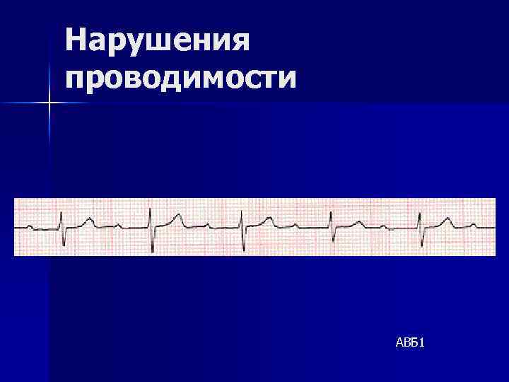 Нарушения проводимости АВБ 1 