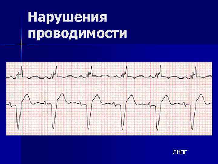 Нарушения проводимости ЛНПГ 