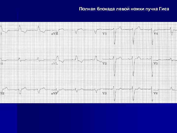 Полная блокада левой ножки пучка Гиса 