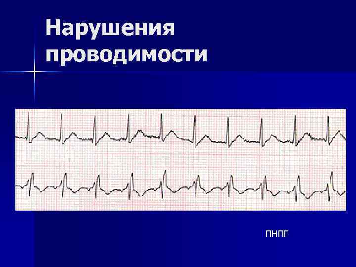 Нарушения проводимости ПНПГ 