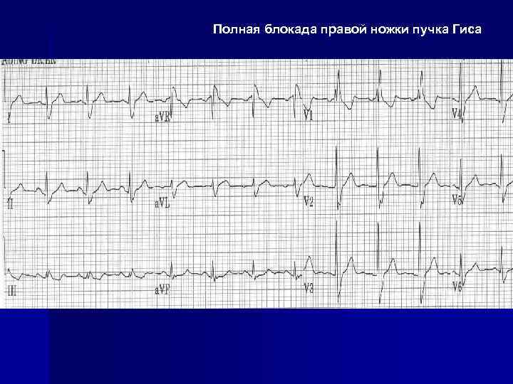 Полная блокада правой ножки пучка Гиса 
