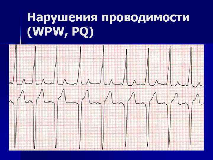 Нарушения проводимости (WPW, PQ) 