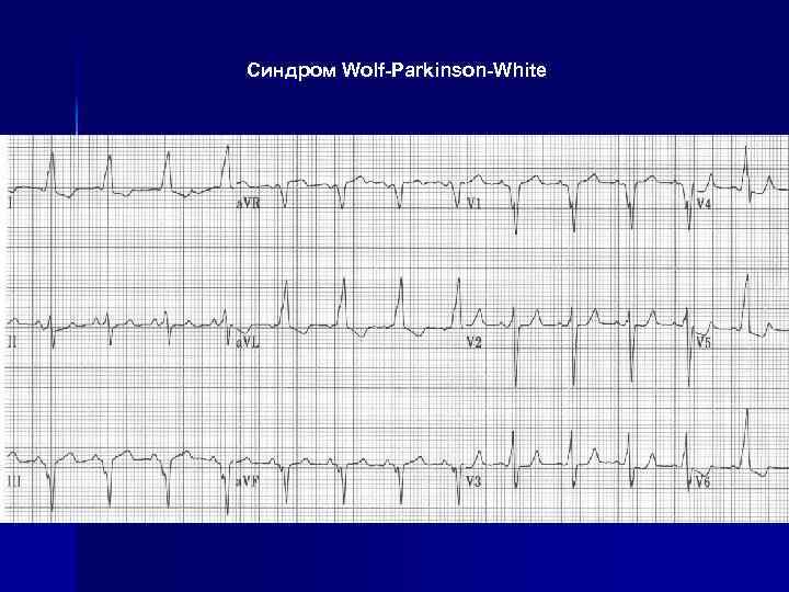 Синдром Wolf-Parkinson-White 