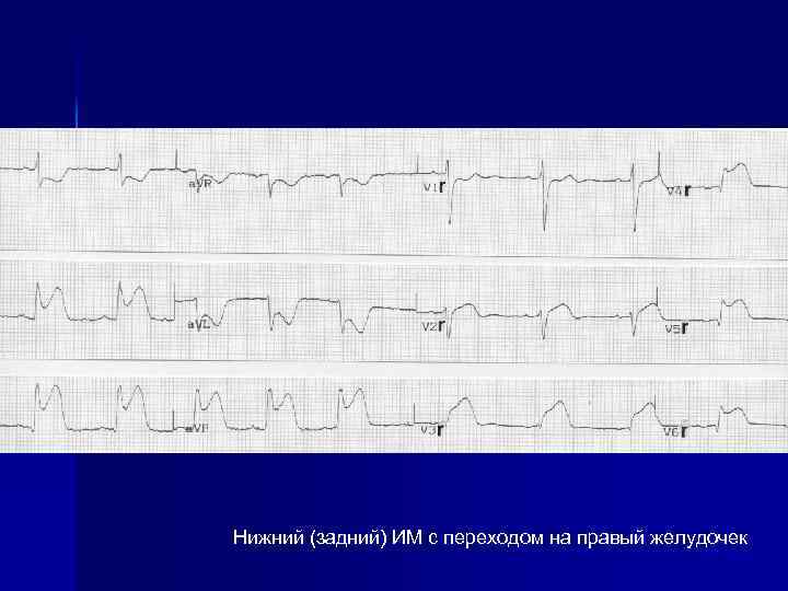 Нижний (задний) ИМ с переходом на правый желудочек 