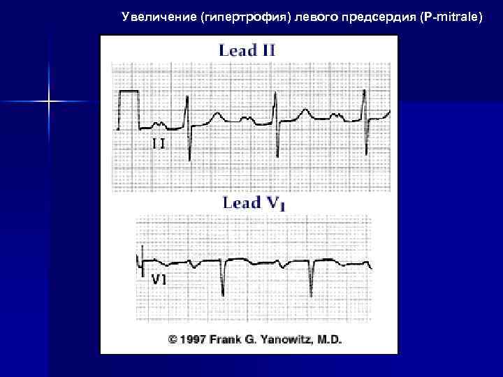 Увеличение (гипертрофия) левого предсердия (P-mitrale) 