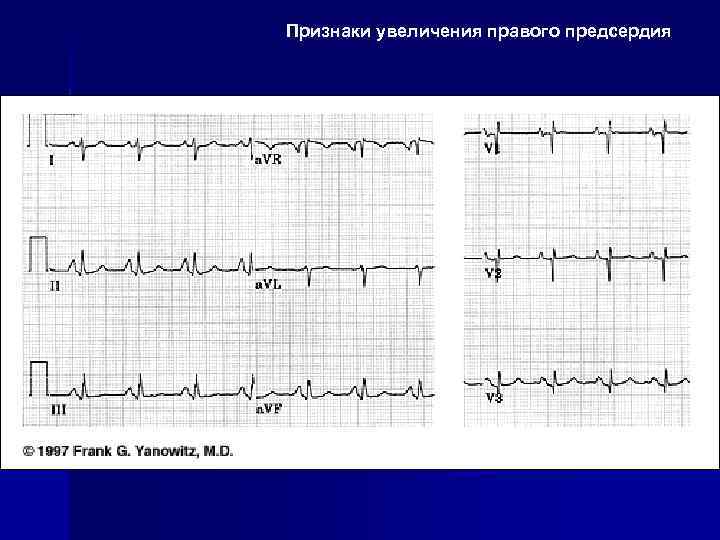 Признаки увеличения правого предсердия 