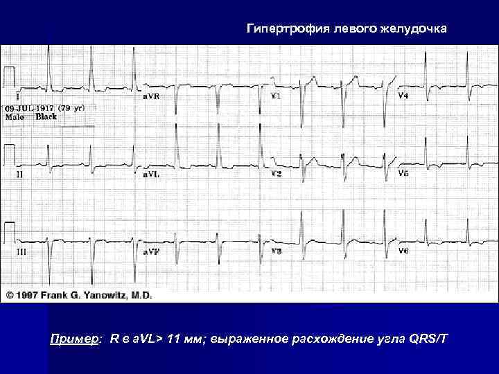 Гипертрофия левого желудочка Пример: R в a. VL> 11 мм; выраженное расхождение угла QRS/T