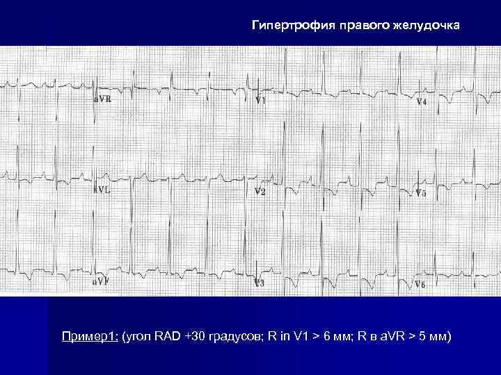 Гипертрофия правого желудочка Пример1: (угол RAD +30 градусов; R in V 1 > 6