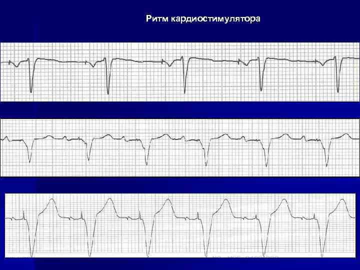 Ритм кардиостимулятора 