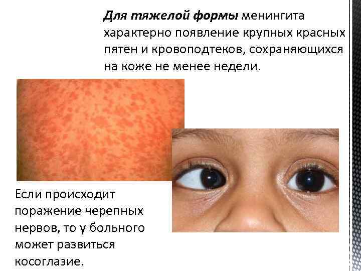 Для тяжелой формы менингита характерно появление крупных красных пятен и кровоподтеков, сохраняющихся на коже