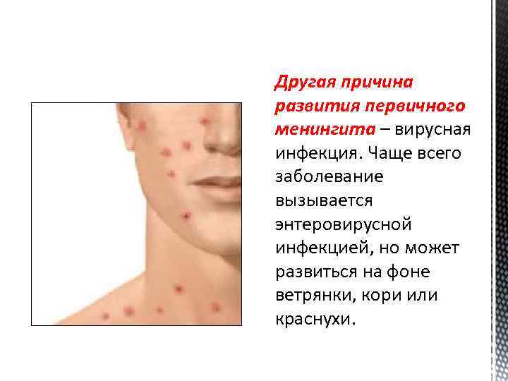 Другая причина развития первичного менингита – вирусная инфекция. Чаще всего заболевание вызывается энтеровирусной инфекцией,