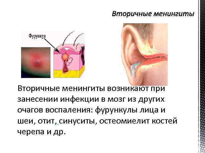 Вторичные менингиты возникают при занесении инфекции в мозг из других очагов воспаления: фурункулы лица
