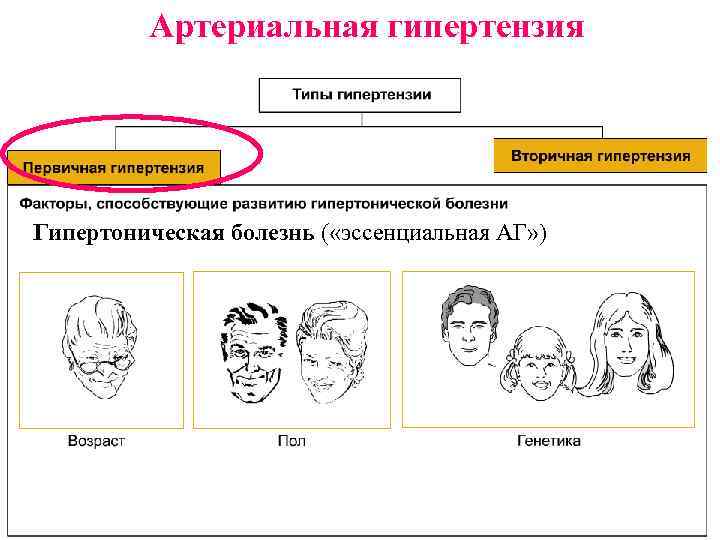 Артериальная гипертензия Гипертоническая болезнь ( «эссенциальная АГ» ) 