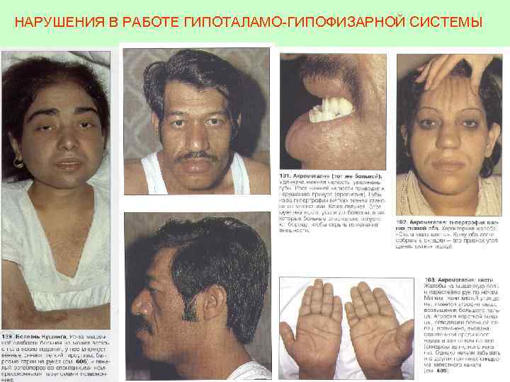 НАРУШЕНИЯ В РАБОТЕ ГИПОТАЛАМО-ГИПОФИЗАРНОЙ СИСТЕМЫ 