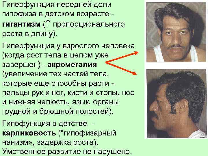 Гиперфункция передней доли гипофиза в детском возрасте гигантизм ( пропорционального роста в длину). Гиперфункция