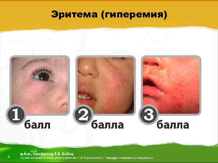 Эритема (гиперемия) 