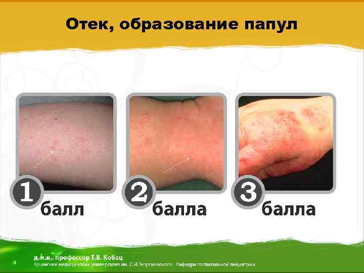 Отек, образование папул 