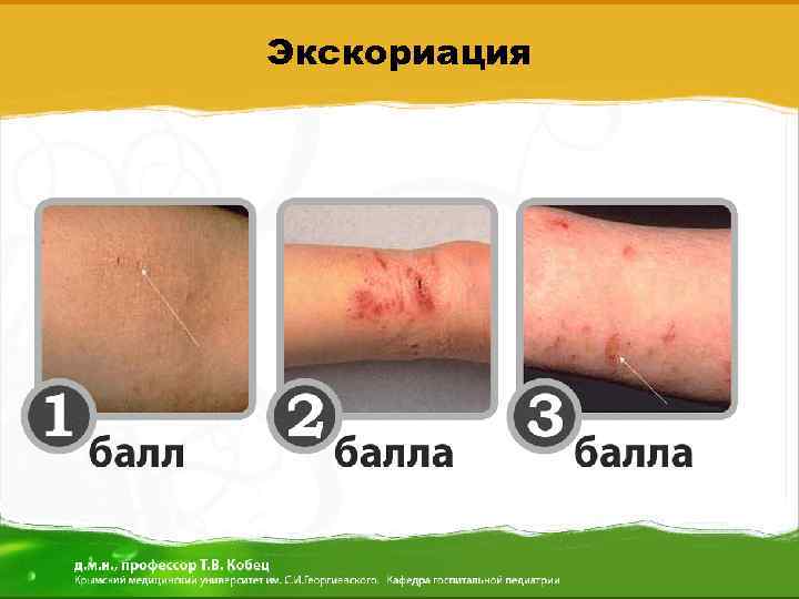 Экскориация 