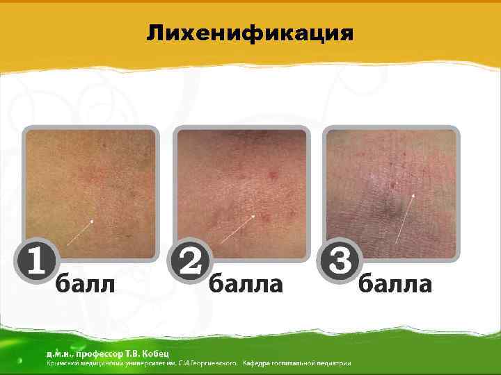 Лихенификация 