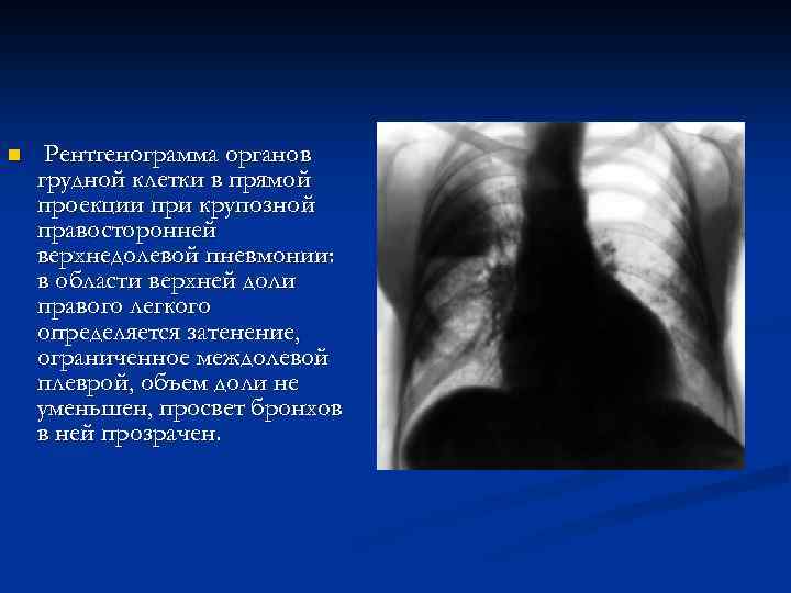n Рентгенограмма органов грудной клетки в прямой проекции при крупозной правосторонней верхнедолевой пневмонии: в