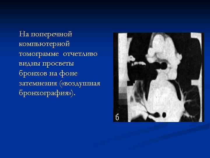 На поперечной компьютерной томограмме отчетливо видны просветы бронхов на фоне затемнения ( «воздушная бронхография»