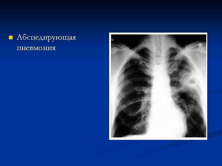 n Абсцедирующая пневмония 