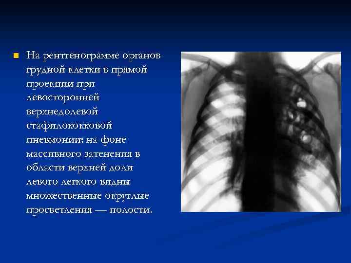 n На рентгенограмме органов грудной клетки в прямой проекции при левосторонней верхнедолевой стафилококковой пневмонии: