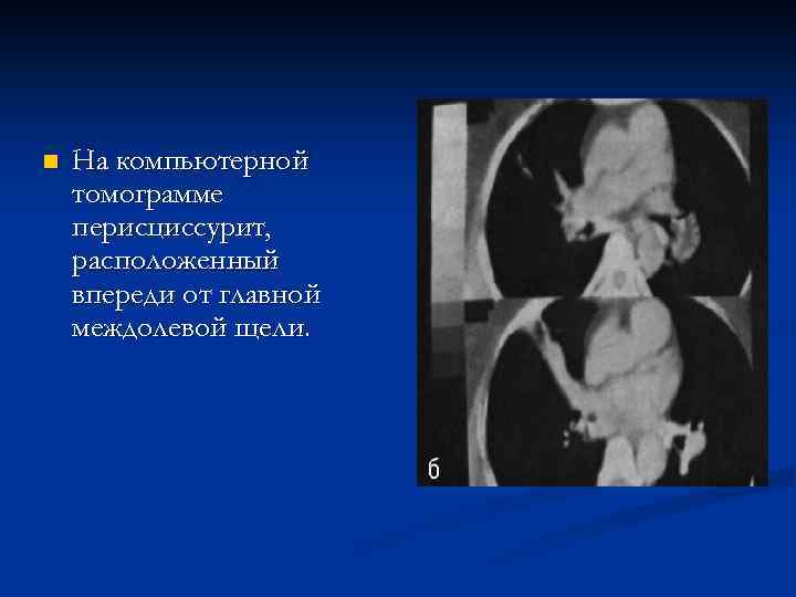n На компьютерной томограмме перисциссурит, расположенный впереди от главной междолевой щели. 