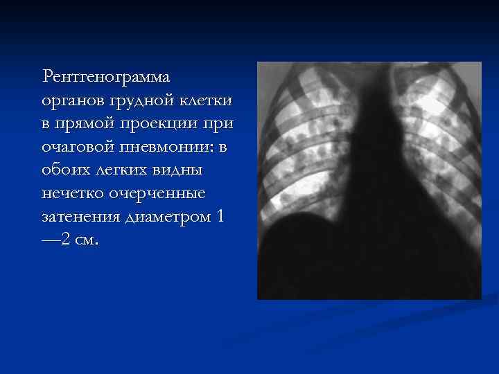 Рентгенограмма органов грудной клетки в прямой проекции при очаговой пневмонии: в обоих легких видны