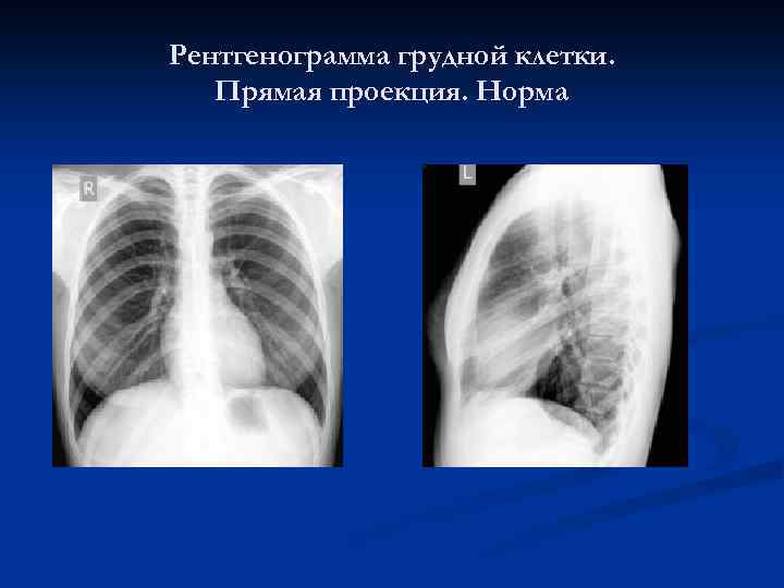 Рентгенограмма грудной клетки. Прямая проекция. Норма 