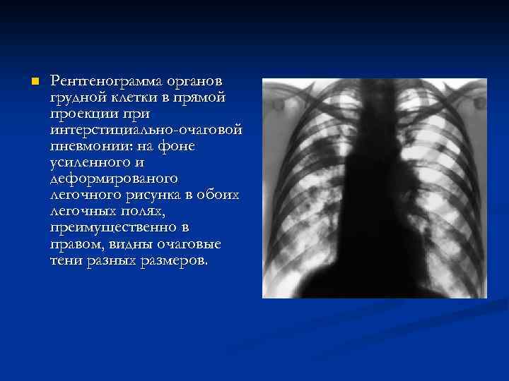 n Рентгенограмма органов грудной клетки в прямой проекции при интерстициально-очаговой пневмонии: на фоне усиленного
